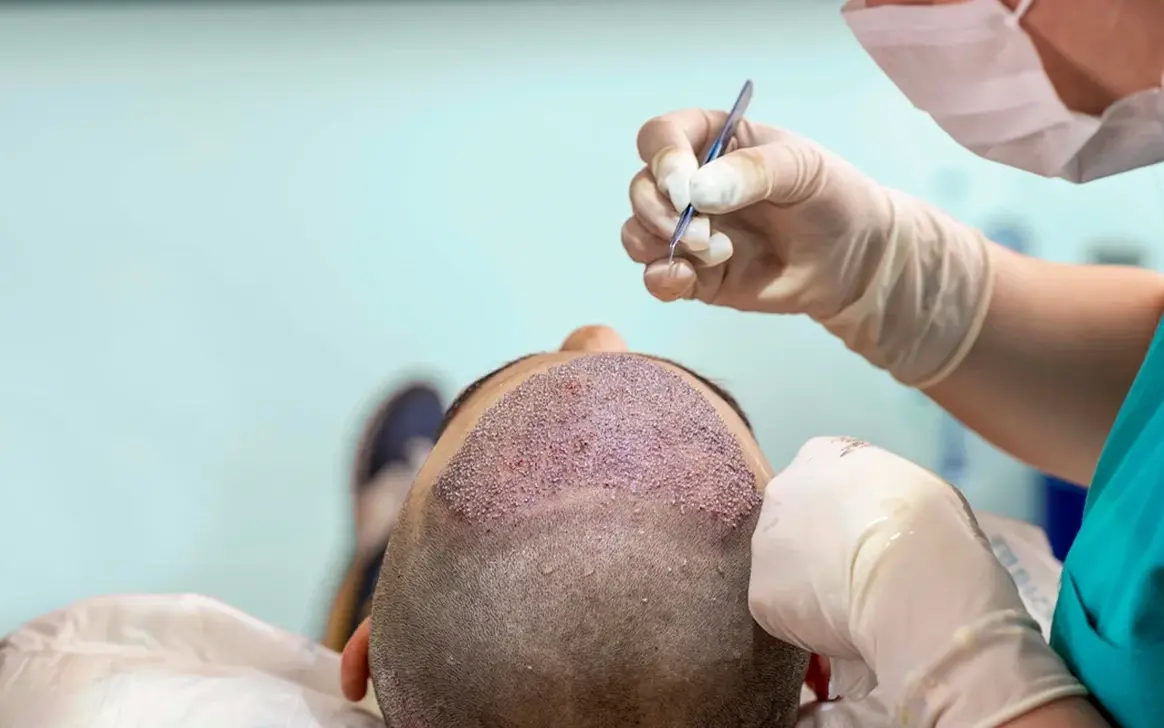 Hair Transplant