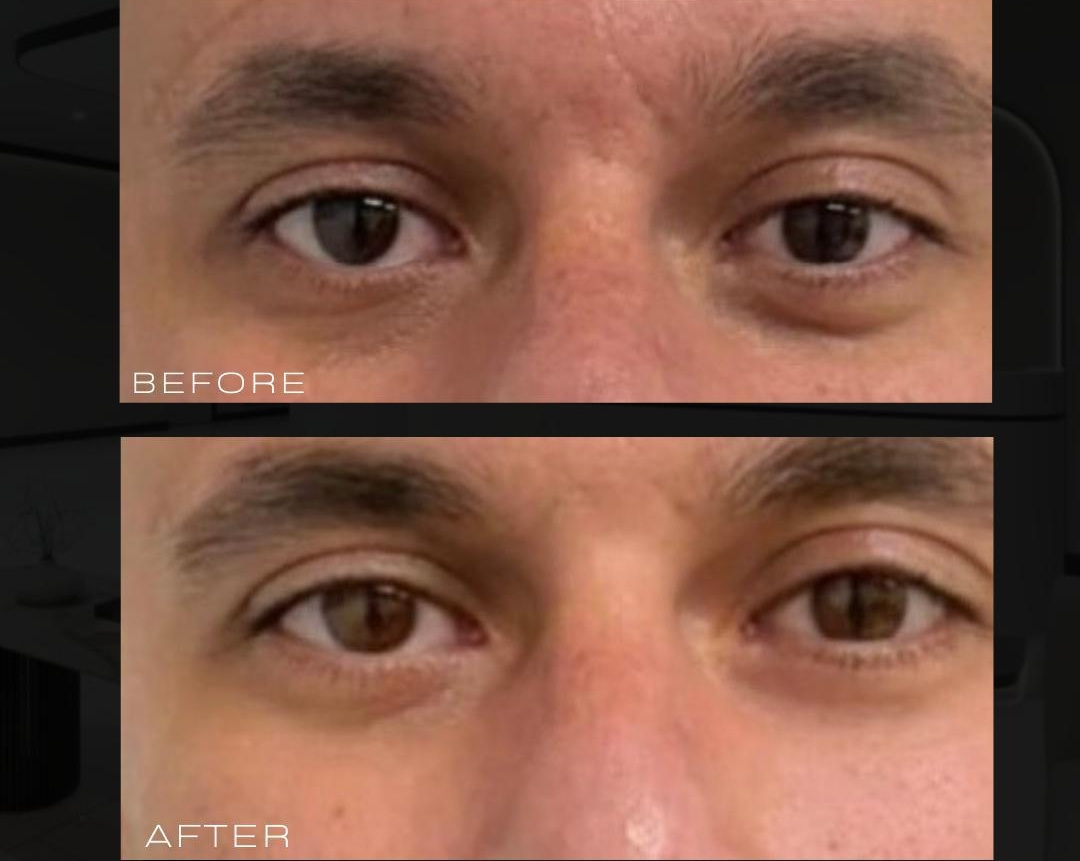 Baby eyes treatment at lamel