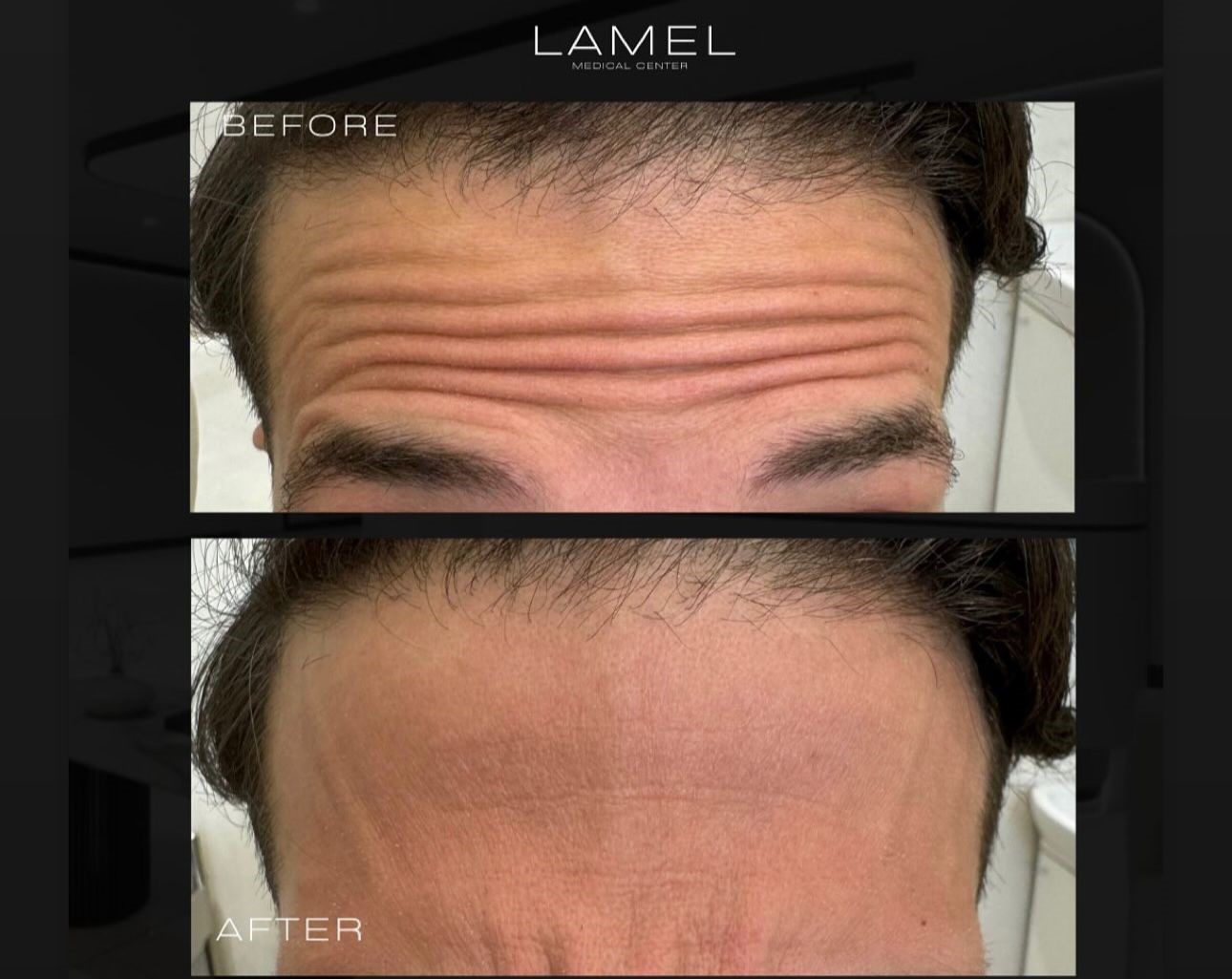 Botox