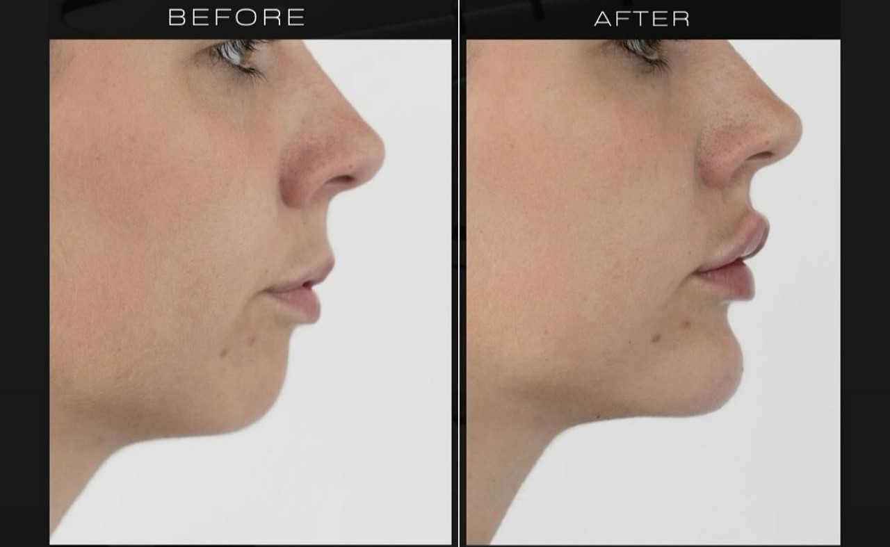 Lips Filler at LAMEL Medical Center