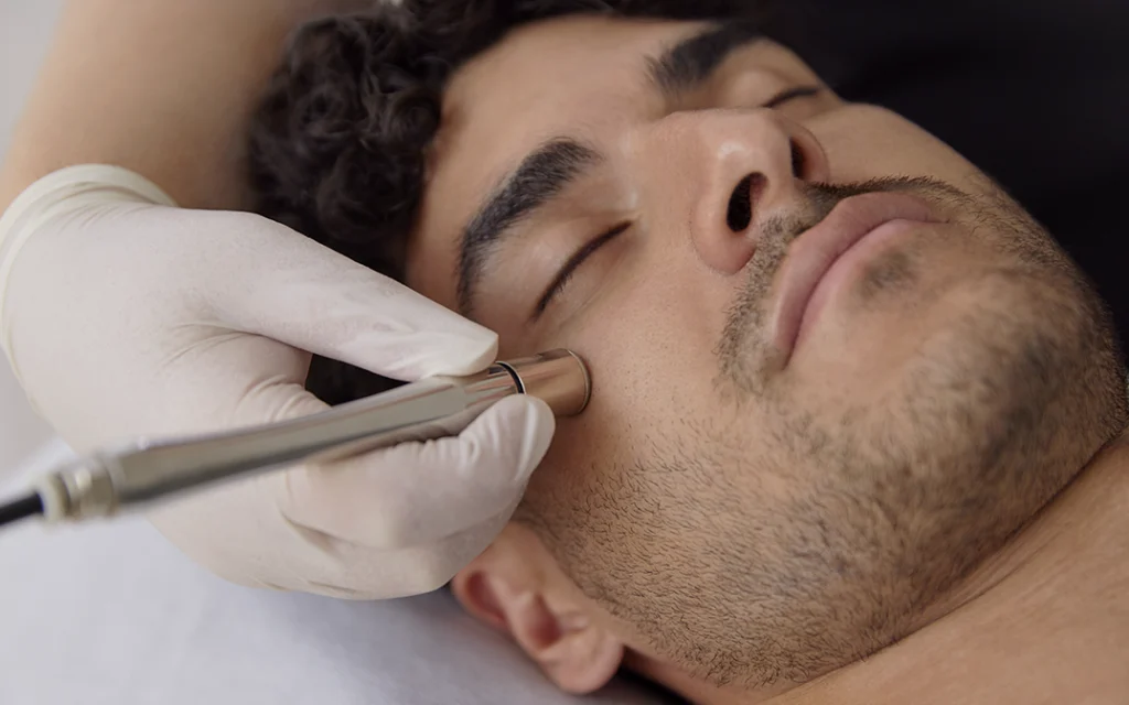 Dermapen Microneedling