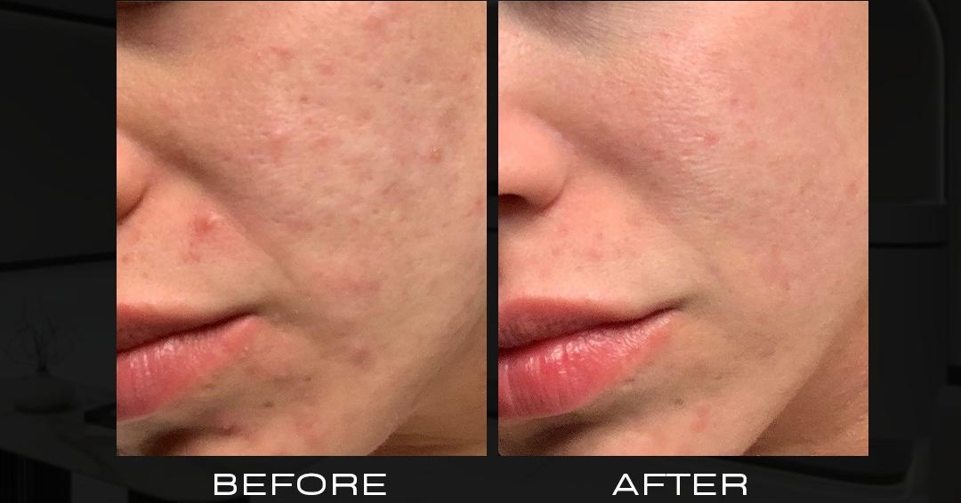 hydra facial at lamel