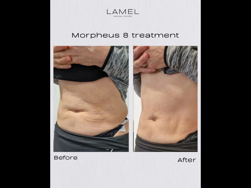 Morpheus 8 At Lamel