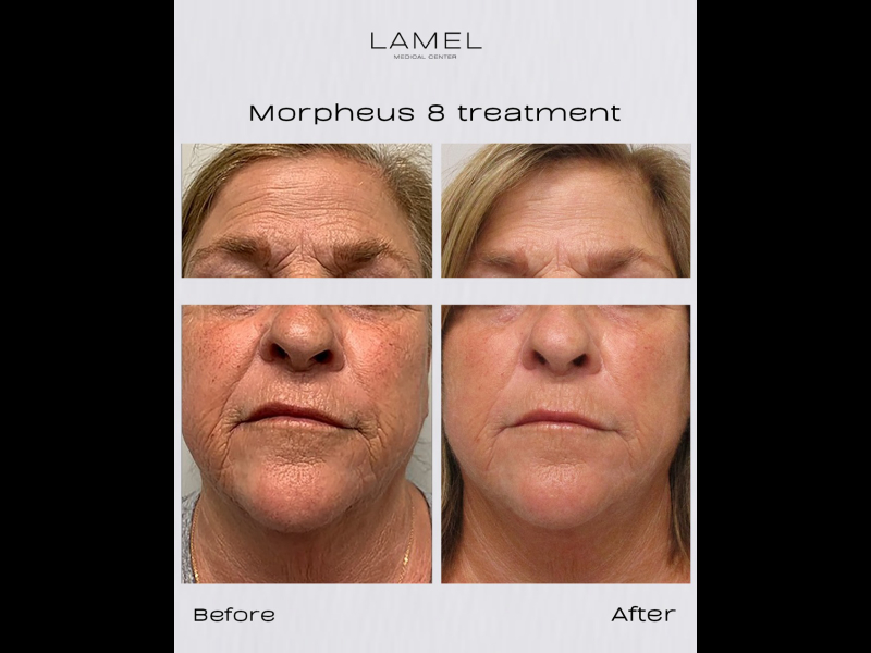 Morpheus 8 At Lamel